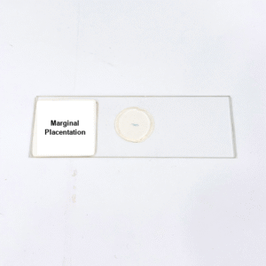 Marginal Placentation